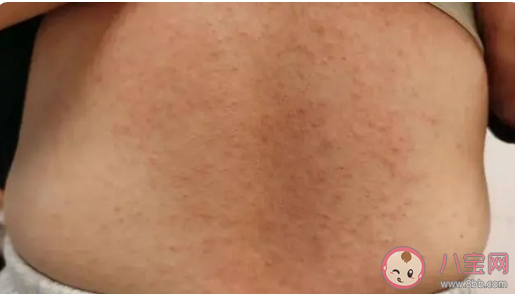 女子混吃7種感冒止咳藥全身長(zhǎng)滿膿皰是怎么回事 多種藥物混吃有什么危害