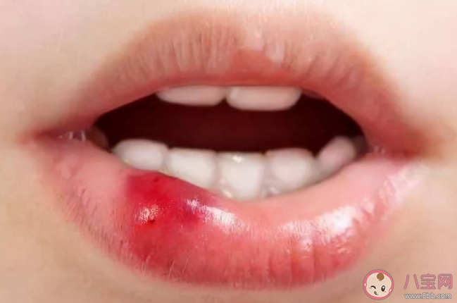 經(jīng)常爛嘴角可能是免疫力差 如何科學(xué)提高自身的免疫力