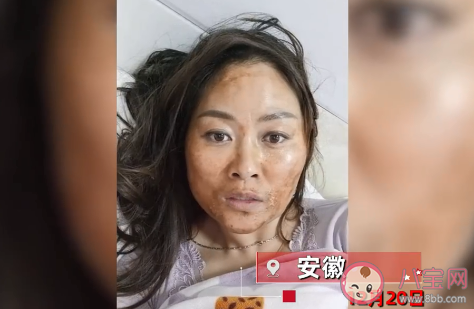 女子感染新冠高燒后滿臉發黑是怎么回事 一般感染新冠會有哪些癥狀