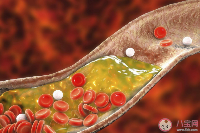 甘油三酯高有什么問題 甘油三酯過高會引起哪些并發(fā)癥