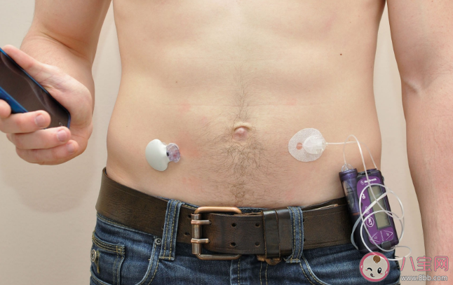 2型糖尿病人工胰腺試驗(yàn)成功是真的嗎 人工胰腺有什么作用 2型糖尿病人工胰腺試驗(yàn)成功是真的嗎 人工胰腺有什么作用