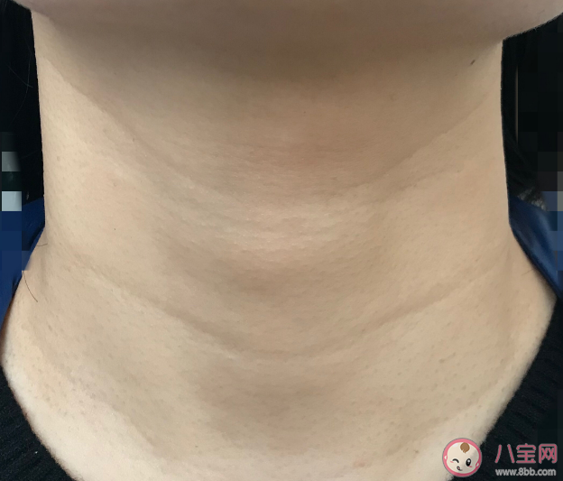 頸紋是如何產生的 頸紋分為哪些等級日常如何預防