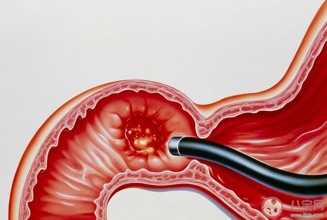 呼氣實驗能夠替代胃鏡嗎 什么人需要進行胃鏡檢查