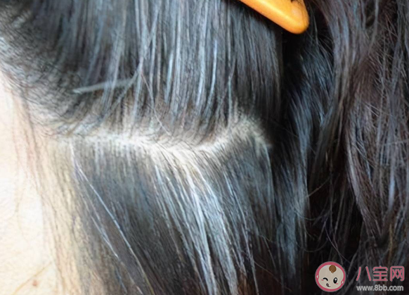 哪些人容易早生白發 避免長白發的7個細節 哪些人容易早生白發 避免長白發的7個細節