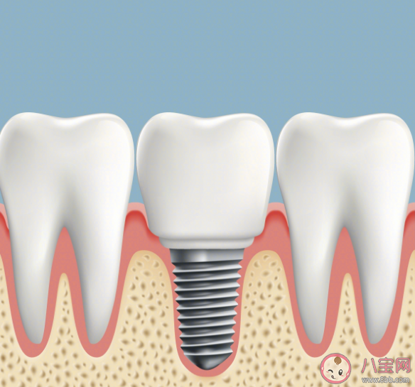 怎樣提高國產種植牙使用率 關于種牙你了解多少