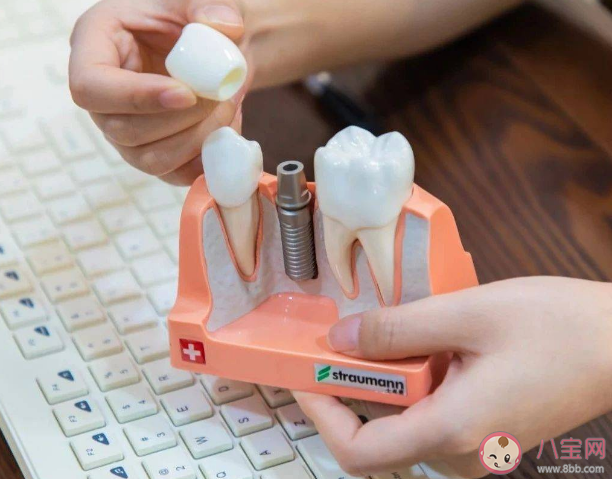 怎樣提高國產種植牙使用率 關于種牙你了解多少