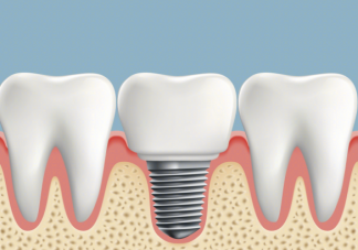 怎樣提高國產(chǎn)種植牙使用率 關于種牙你了解多少