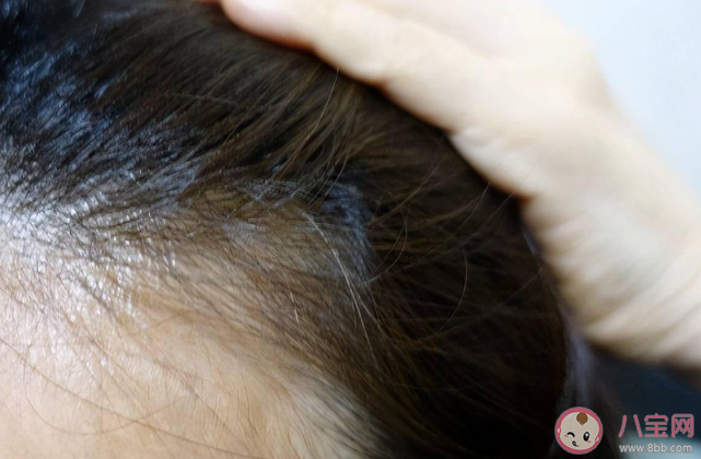 7類人容易提前長白發 如何控制白發增多 7類人容易提前長白發 如何控制白發增多