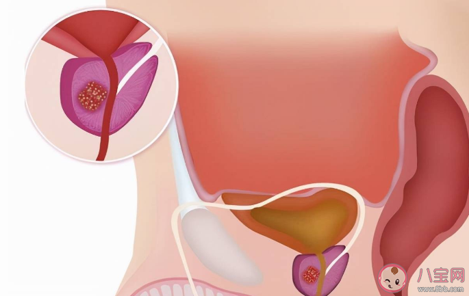 為什么說前列腺是男性的生命腺 排尿超60秒要查前列腺嗎