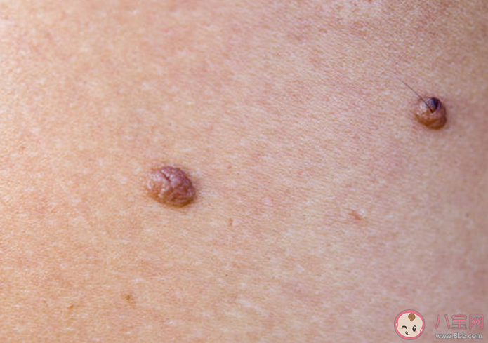 什么樣的痣會癌變 哪些部位的痣要多加注意 什么樣的痣會癌變 哪些部位的痣要多加注意