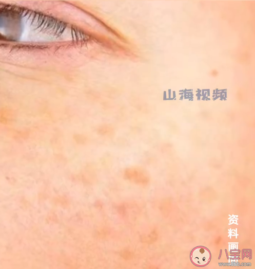 25歲女生長期熬夜長出老年斑 年輕人為什么會長老年斑