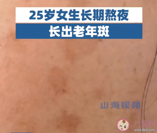 25歲女生長期熬夜長出老年斑 年輕人為什么會長老年斑