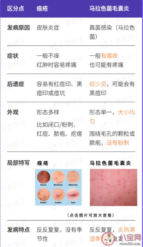 為什么背后的痘痘去不掉 背上長痘痘怎么辦