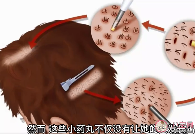 女子吃600顆增發藥致肝損傷 如何預防藥物性肝損傷 女子吃600顆增發藥致肝損傷 如何預防藥物性肝損傷