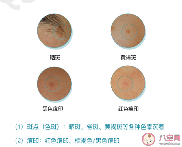 斑點痘印成因到底是什么 如何科學淡斑淡痘印