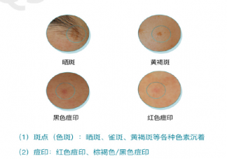 斑點痘印成因到底是什么 如何科學(xué)淡斑淡痘印