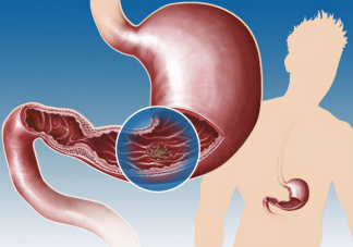 感染了幽門螺桿菌沒有不適要治療嗎 如何正確應(yīng)對幽門螺桿菌