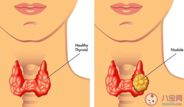 有些食物是結(jié)節(jié)催化劑 不同結(jié)節(jié)體質(zhì)的忌口清單