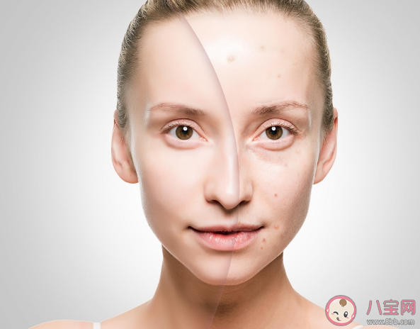 不同部位長痘的真正原因 拯救痘痘肌的小竅門