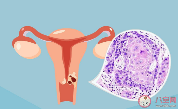 子宮內膜癌做試管有影響嗎 子宮內膜癌有哪些危險因素