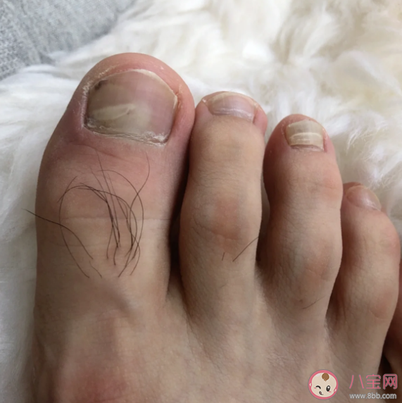 踢到腳趾為什么這么疼 踢到腳趾很疼怎么辦