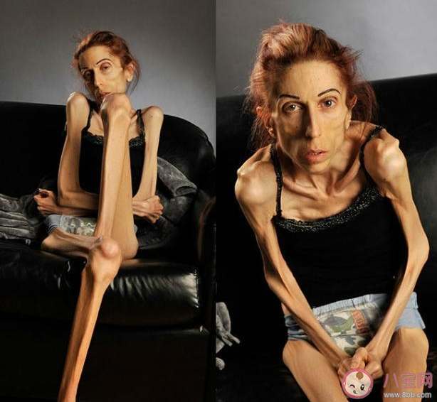 22歲姑娘因男友減到55斤進醫院 要不要為愛減肥 22歲姑娘因男友減到55斤進醫院 要不要為愛減肥