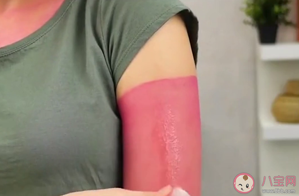 哪種膚色更容易曬黑 哪些部位最容易被曬傷