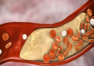建議每天脂肪攝入控制在20至25克以內(nèi) 生活中如何科學(xué)降血脂