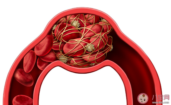 體檢發現頸動脈斑塊嚴重嗎 長了頸動脈斑塊怎么辦