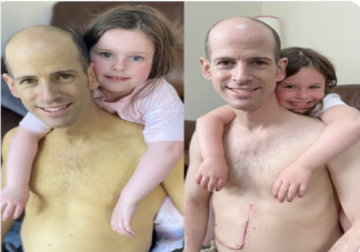 肝臟移植前后膚色對比 為什么肝臟好壞會顯在皮膚上