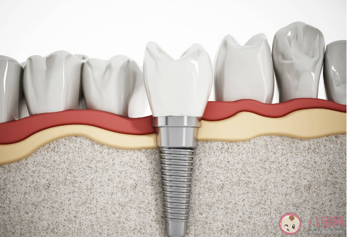 種植牙可以使用一輩子嗎 種植牙多久后要復查