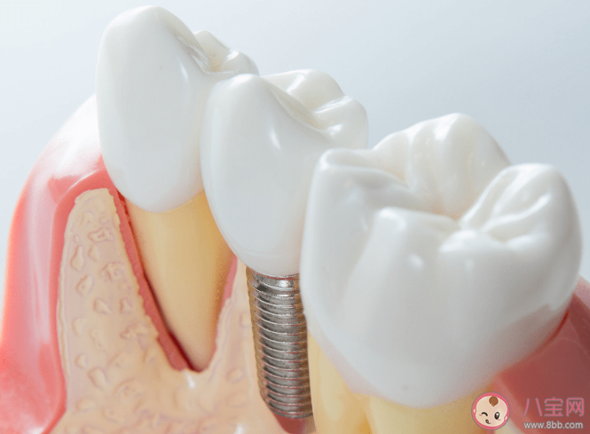 種植牙可以使用一輩子嗎 種植牙多久后要復查