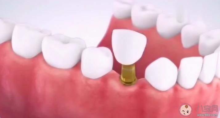 種植牙使用壽命為什么相差這么大 種植牙與天然牙有何不同 種植牙使用壽命為什么相差這么大 種植牙與天然牙有何不同