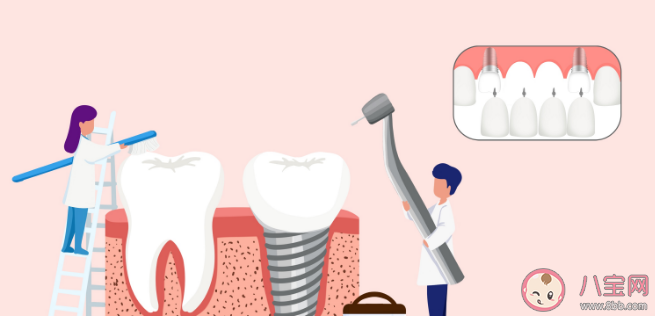 種植牙使用壽命為什么相差這么大 種植牙與天然牙有何不同 種植牙使用壽命為什么相差這么大 種植牙與天然牙有何不同