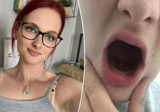 26歲女子生完孩子牙齒掉光是怎么回事 孕吐會導致掉牙嗎