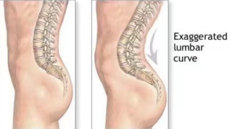 什么會導致死臀綜合征 死臀綜合征如何鍛煉改善 什么會導致死臀綜合征 死臀綜合征如何鍛煉改善