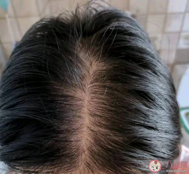 頭發大量脫落的原因有哪些 哪些生活習慣會影響頭發生長 頭發大量脫落的原因有哪些 哪些生活習慣會影響頭發生長