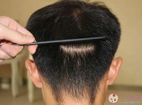 植發所用的毛發通常是自己的還是別人的 螞蟻莊園7月19日答案