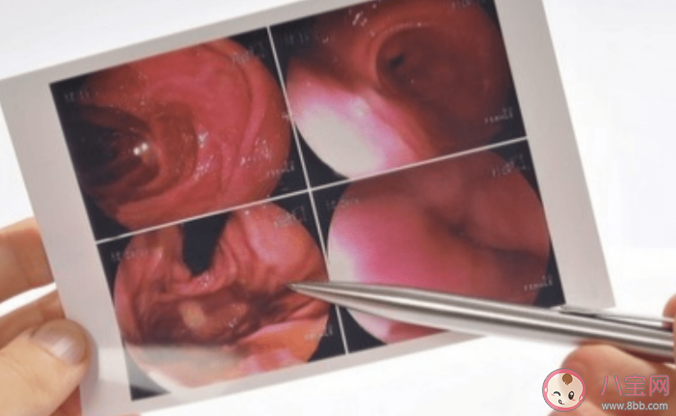 為什么做胃鏡還要查梅毒和艾滋病 胃腸鏡檢查的流程是怎樣的