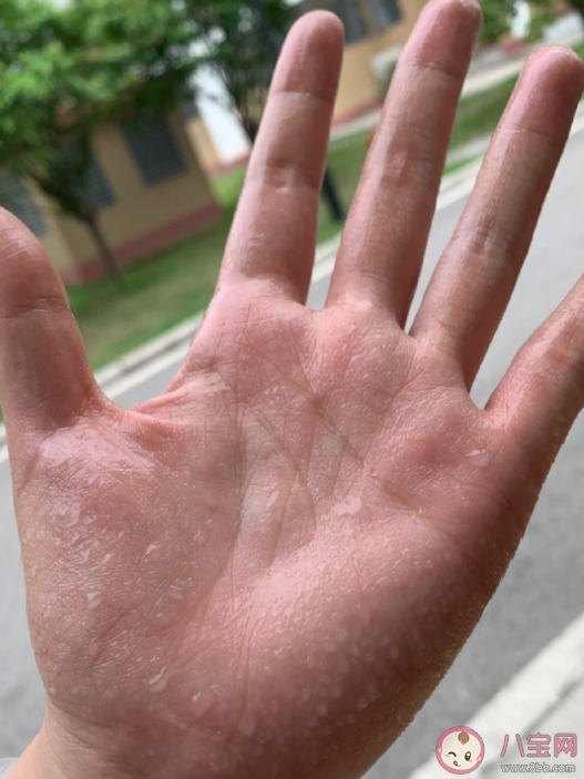 手汗癥為什么要去胸外科治療 手汗癥需要手術治療嗎