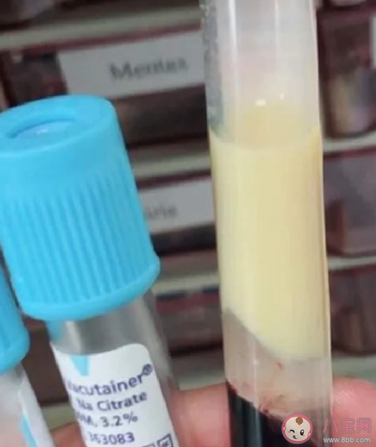 血液為什么會變成白色 哪些人更容易出現牛奶血 血液為什么會變成白色 哪些人更容易出現牛奶血