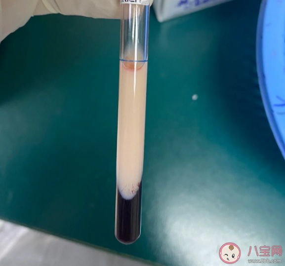 血液為什么會變成白色 哪些人更容易出現牛奶血 血液為什么會變成白色 哪些人更容易出現牛奶血