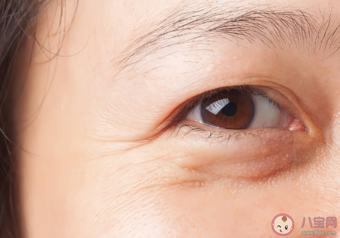 眼袋會遺傳嗎 如何科學改善眼袋