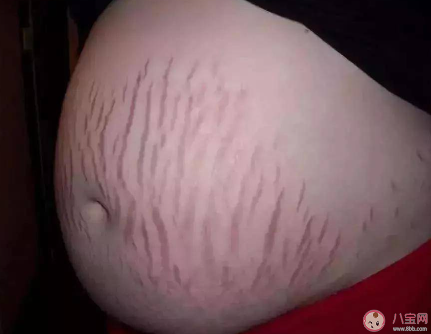 女子花2萬修復妊娠紋無效起訴退款 妊娠紋后期能被修復嗎