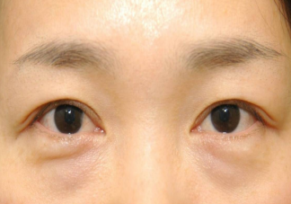 眼袋會遺傳嗎 如何科學改善眼袋