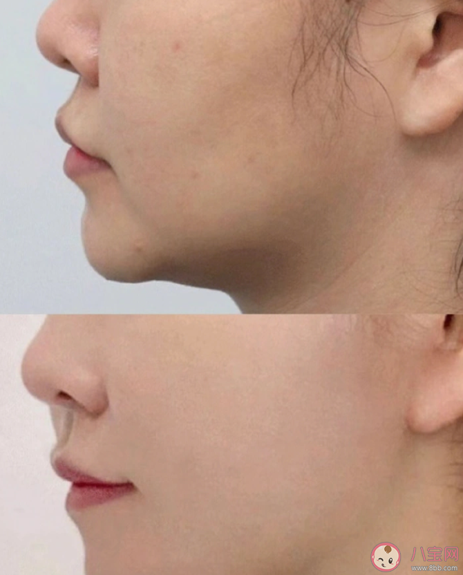 女子過海關雙腿綁滿少女針是怎么回事 少女針是什么