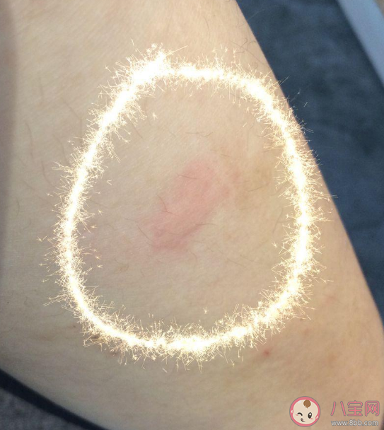 過敏原檢測(cè)是智商稅嗎 過敏原檢測(cè)要不要查