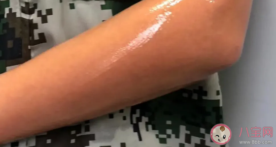 清涼噴霧會凍傷皮膚嗎 清涼噴霧有什么危害