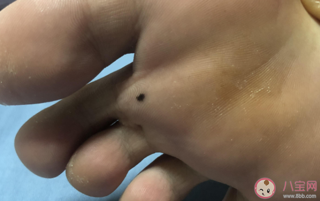 腳底長痣容易惡變嗎 4個做法會使黑痣癌變