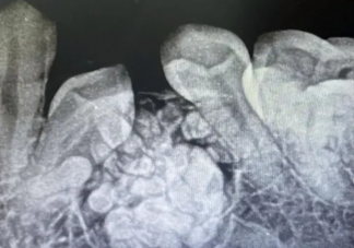 牙瘤的發病原因是什么 牙瘤嚴重嗎